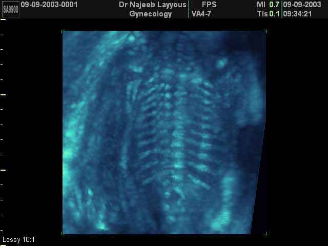 3D Photos échographie du squelette du fœtus