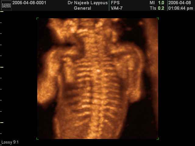 Fetal Skeleton
