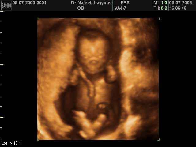 First Trimester Photos