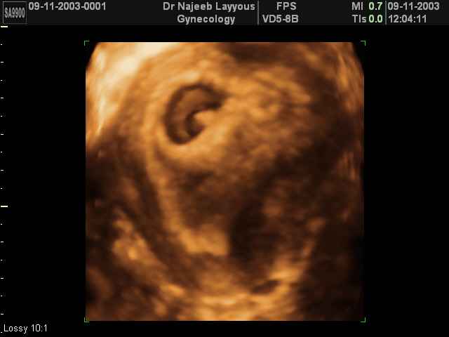 First Trimester Photos