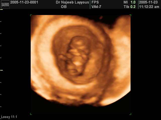 First Trimester Photos