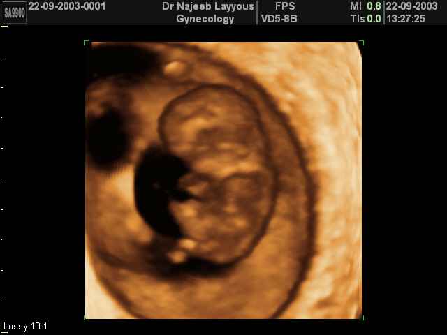 Photos d’échographie de tôt grossesse