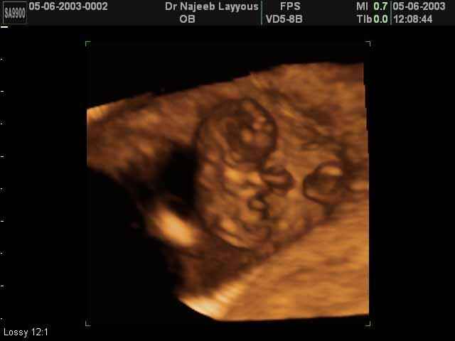 First Trimester Photos