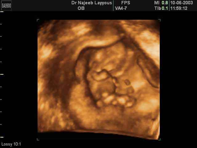 First Trimester Photos