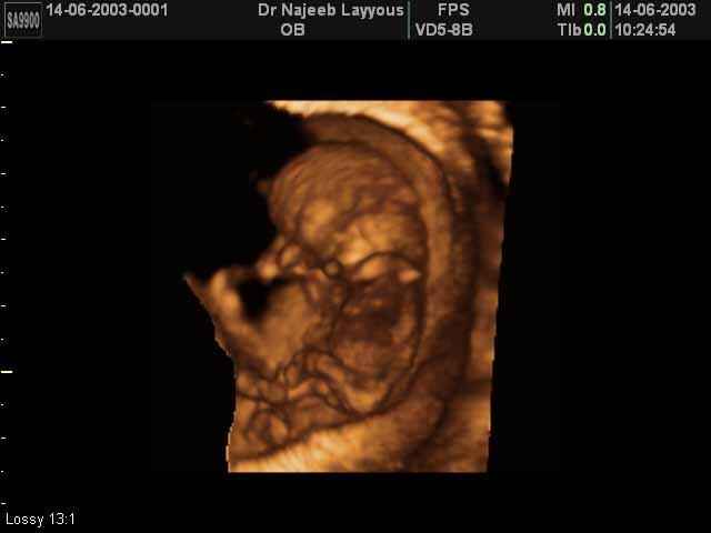 First Trimester Photos