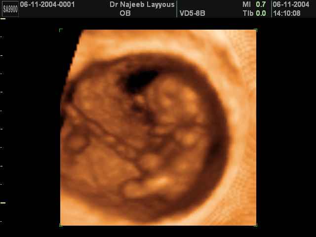 First Trimester Photos