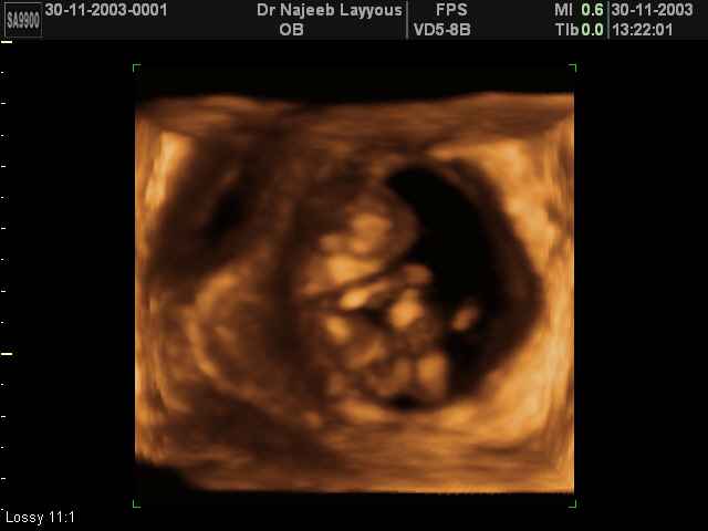 First Trimester Photos