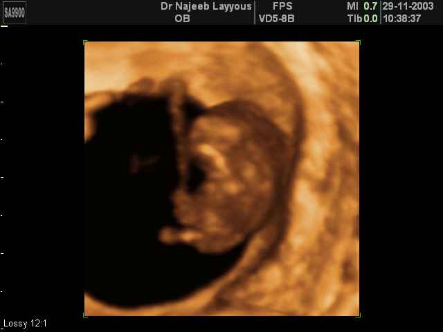 صور للجنين في المراحل الأولى من الحمل