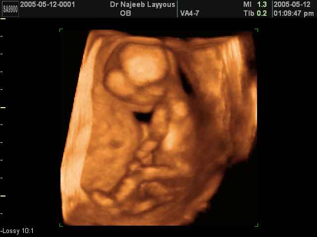 Photos d’échographie de tôt grossesse