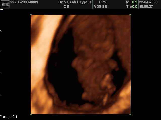 Nine Weeks Fetus