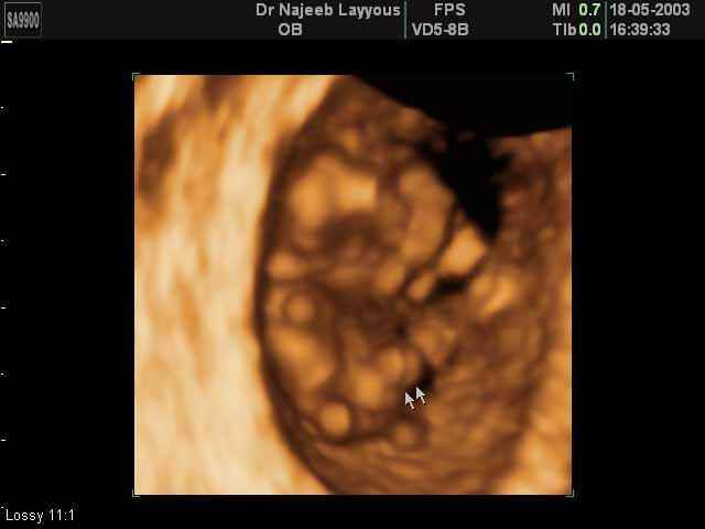 Physiological Umbilical Hernia at Nine Weeks