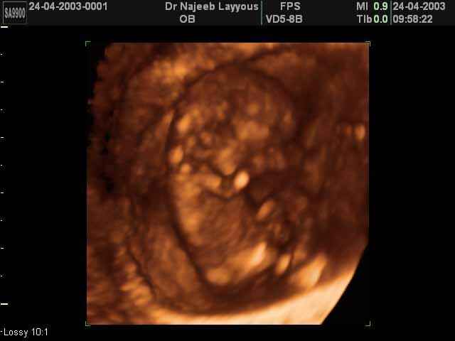 Ten Weeks Fetus