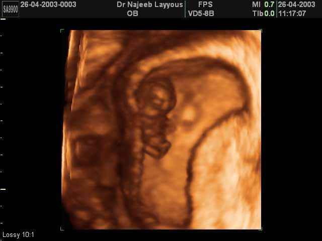 Ten Weeks Fetus