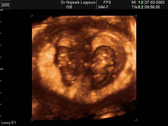 Eleven Weeks Twins Pregnancy