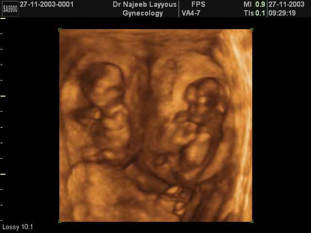 Twins Pregnancy