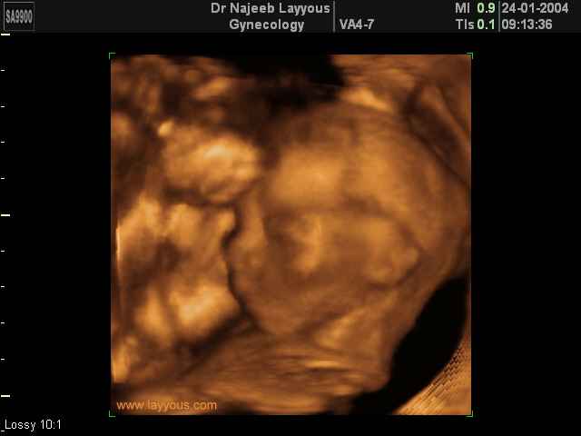 3D Second Trimester