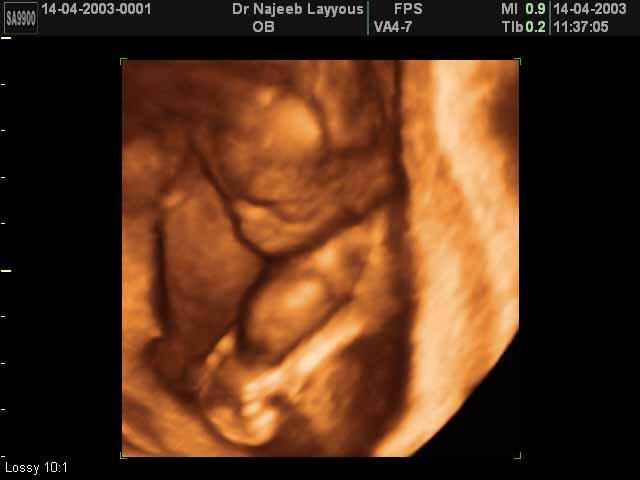 3D Second Trimester