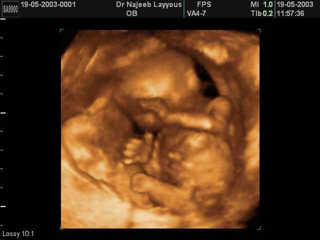 3D Second Trimester