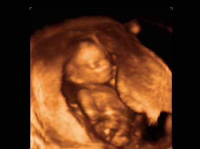 3D Second Trimester