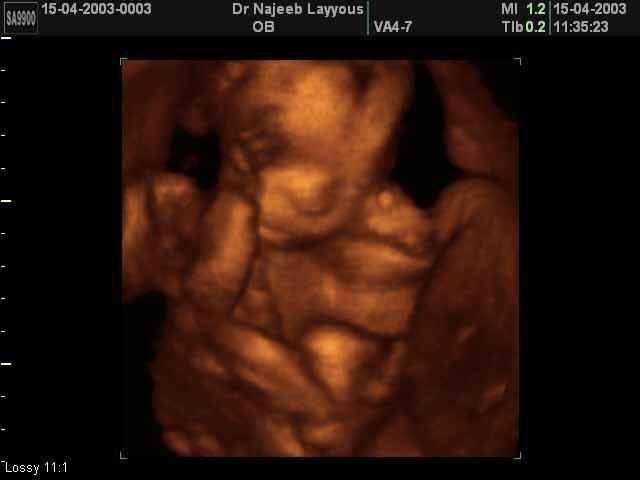 3D Second Trimester