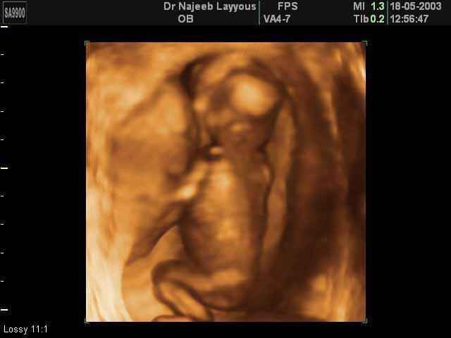 3D Second Trimester