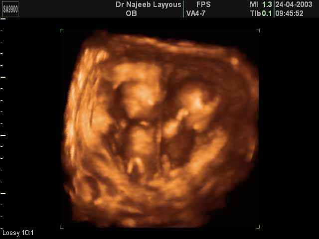 3D Second Trimester