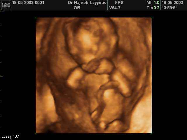 3D Second Trimester