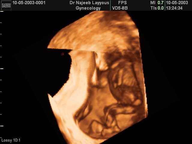 3D Second Trimester