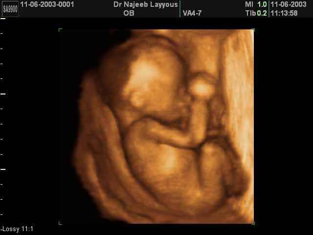 3D Second Trimester