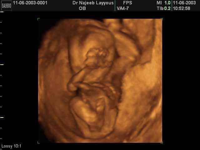 3D Second Trimester