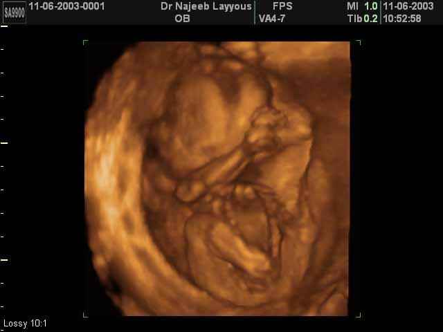 3D Second Trimester