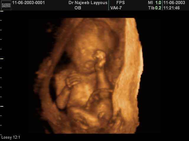 3D Second Trimester