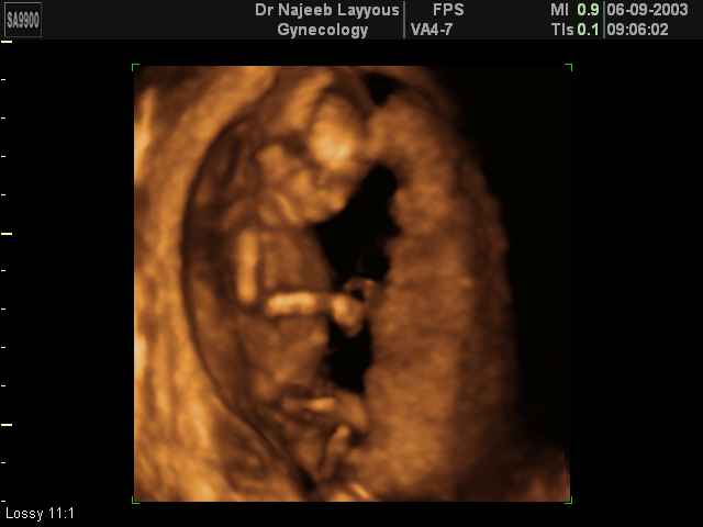 3D Second Trimester