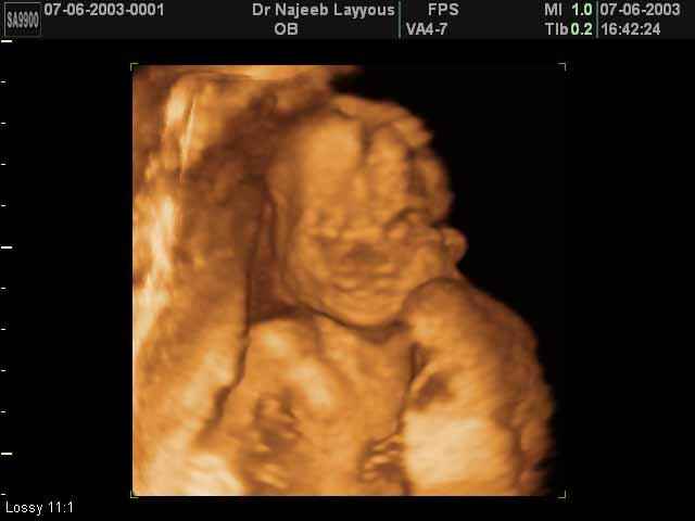 3D Second Trimester