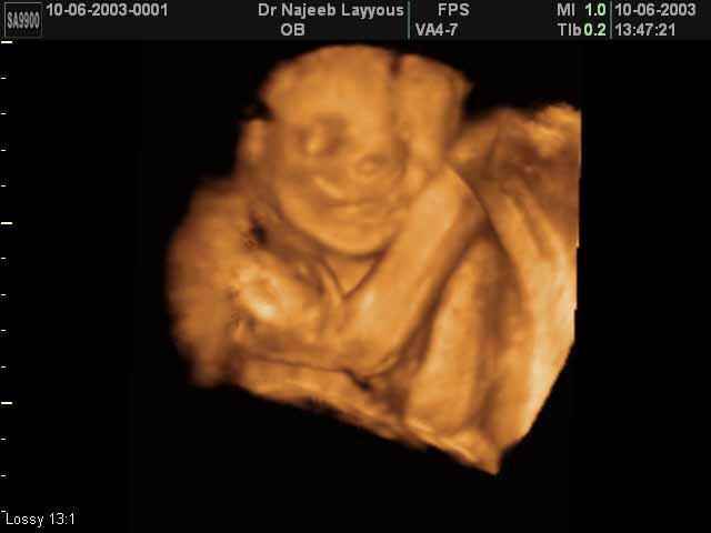 3D Second Trimester