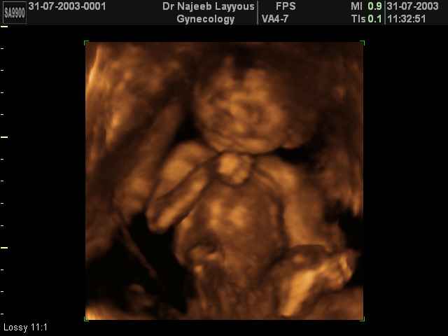 3D Second Trimester