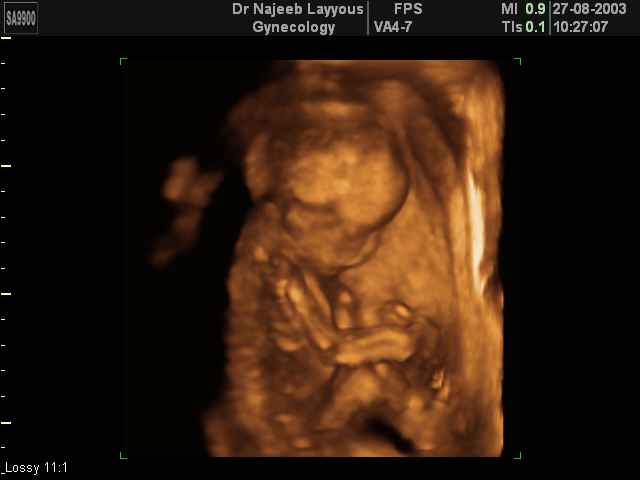 3D Second Trimester