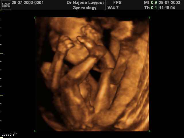 3D Second Trimester