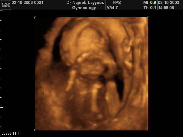 3D Second Trimester