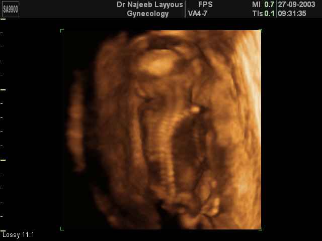 3D Second Trimester