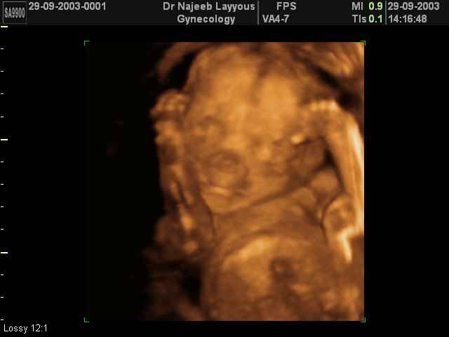 3D Second Trimester