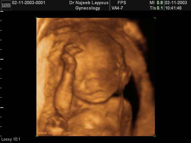 3D Second Trimester