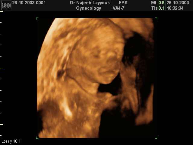 3D Second Trimester