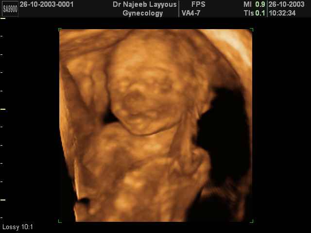 3D Second Trimester