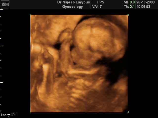 3D Second Trimester