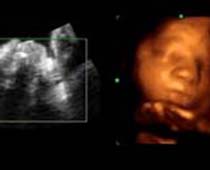 4D ultrasons expressions du visage d'un fœtus. Agrafe 5