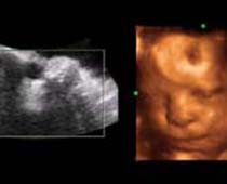4D ultrasons expressions du visage d'un foetus 4
