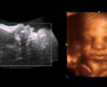 Échographie 4D un visage fœtale