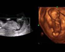 4D Ultrasound a Happy 11+ Weeks old Fetus