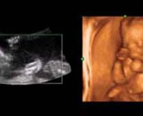 Échographie 4D une boxe fœtus